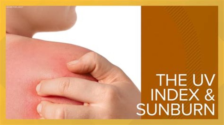 Doxycycline Sunburn Hands: Understanding the Risks and How to Protect Your Skin